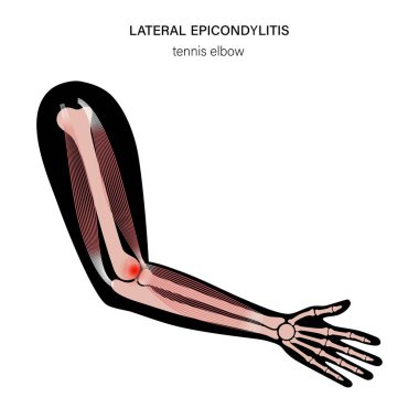 Yan epikondilit tenis dirseği.