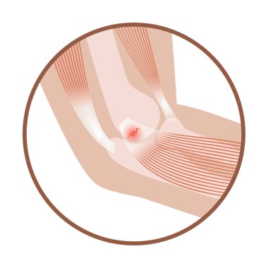 Orta epikondilit golfçü dirseği