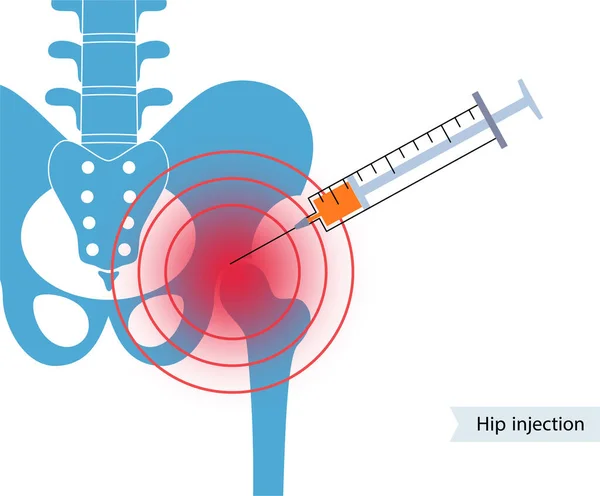 Kalça eklemi enjeksiyonu — Stok Vektör