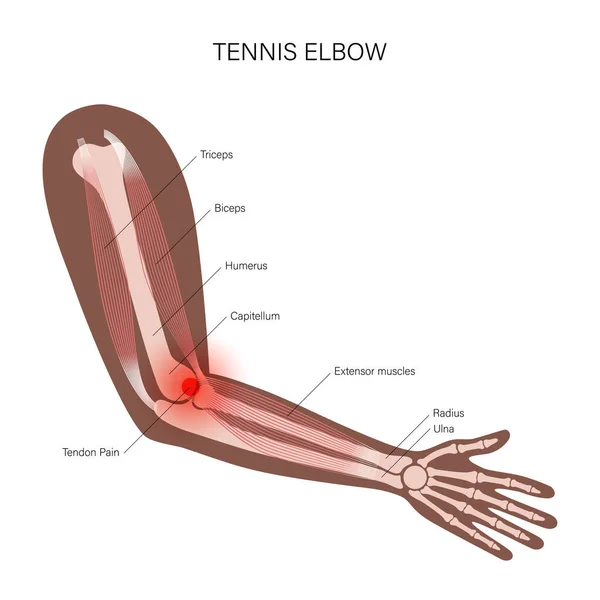 Eicondilitis lateral codo de tenista — Vector de stock