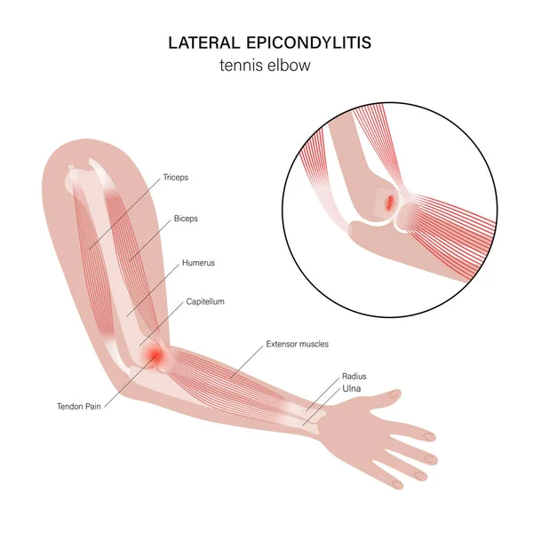 Eicondilitis lateral codo de tenista — Vector de stock
