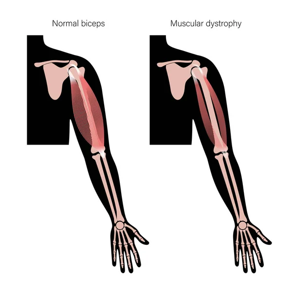 Músculos del brazo humano — Vector de stock