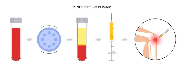 Bloedplaatjes rijk plasma concept — Stockvector