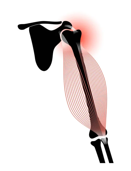 Bicipiti lacrimazione trauma — Vettoriale Stock