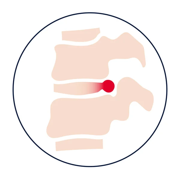 Concepto de hernia intervertebral — Archivo Imágenes Vectoriales