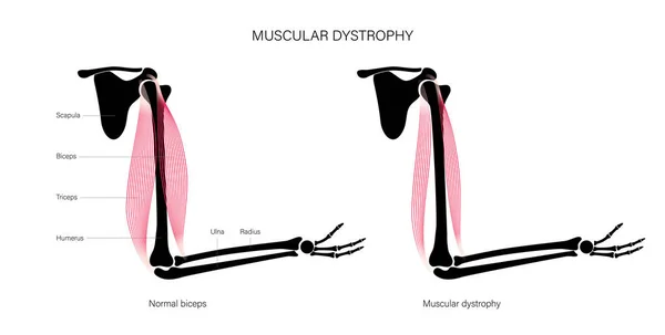 Muscular dystrophy of arm — Stock Vector