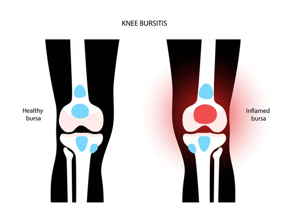 Bursitis gyulladás koncepció — Stock Vector