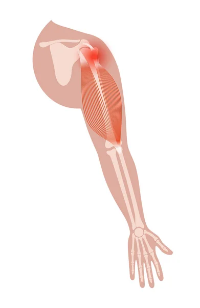 Trauma por lesão do bíceps — Vetor de Stock