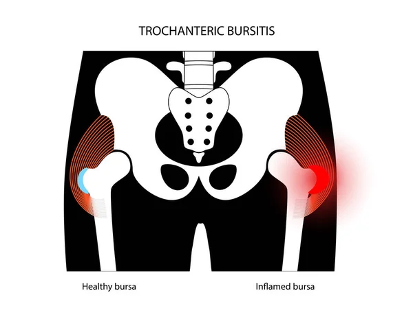 Bursitis gyulladás koncepció — Stock Vector