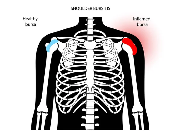 Bursitis iltihaplanma kavramı — Stok Vektör