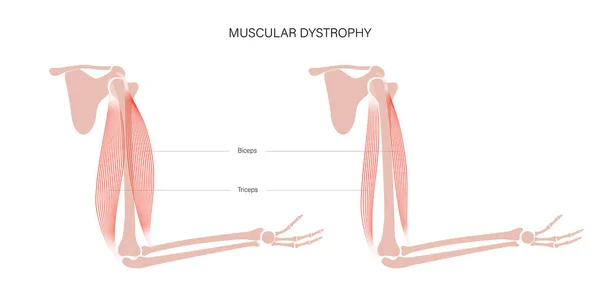 Dystrofia mięśni ramienia — Wektor stockowy