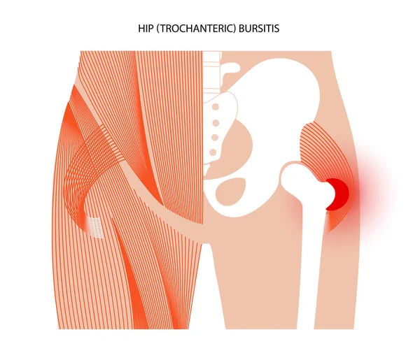 Concepto de inflamación de bursitis — Vector de stock