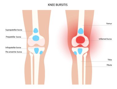 Bursitis iltihaplanma kavramı