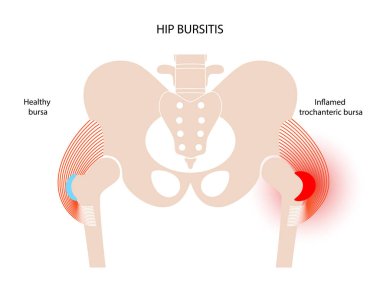 Bursitis iltihaplanma kavramı