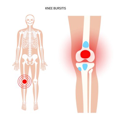 Bursitis iltihaplanma kavramı