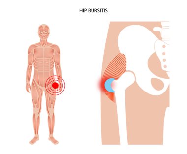 Bursitis iltihaplanma kavramı