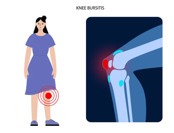 Ontstekingsconcept van Bursitis — Stockvector