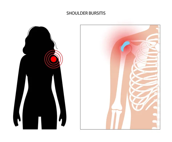 Bursitis gyulladás koncepció — Stock Vector