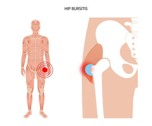 Concept d'inflammation bursite — Image vectorielle