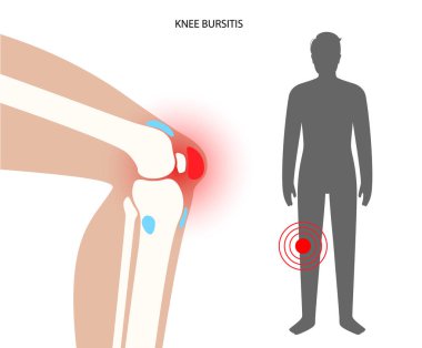Bursitis iltihaplanma kavramı