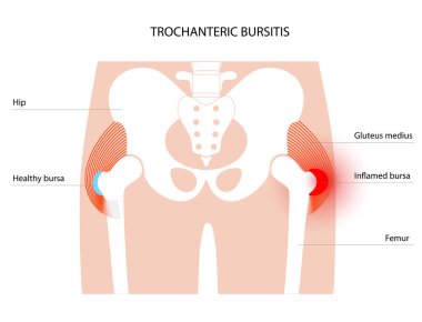 Bursitis inflammation concept clipart