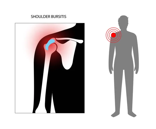 Entzündungskonzept für Bursitis — Stockvektor