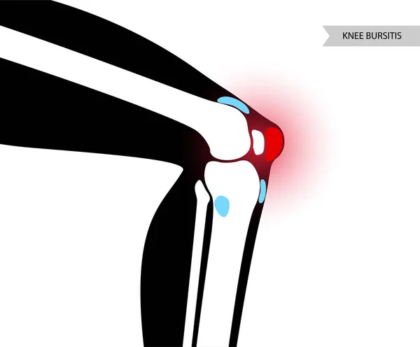 Concepto de inflamación de bursitis — Archivo Imágenes Vectoriales