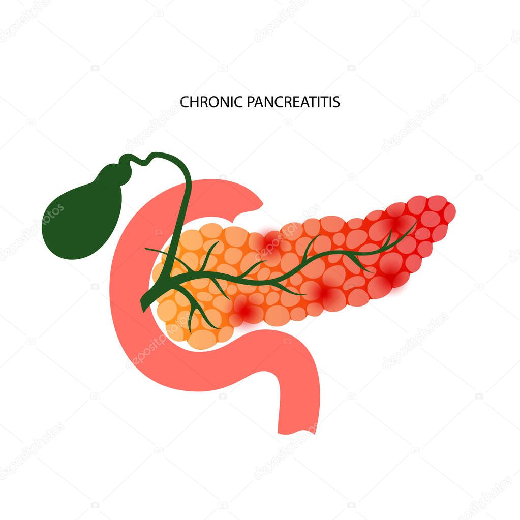 Pancreas disease logo, chronic pancreatitis. Medical appointment, examination and treatment in clinic. Pain and inflammation in human internal organs. Anatomical examination flat vector illustration.