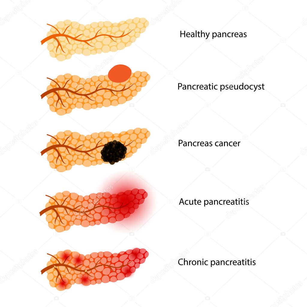 Pancreas disease concept. Acute and chronic pancreatitis, pancreatic cancer and pseudocyst. Pain and inflammation in digestive system. Human internal organs anatomical examination vector illustration.
