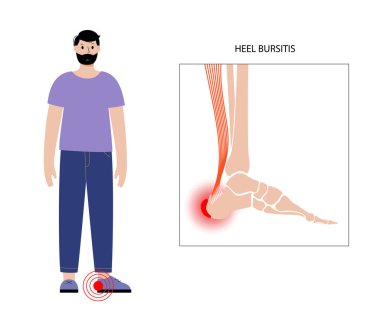 Bursitis iltihaplanma kavramı