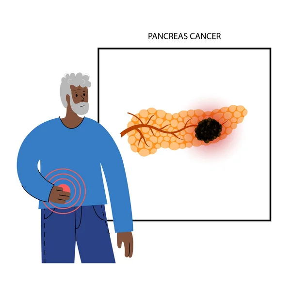 胰腺疾病和癌症 — 图库矢量图片