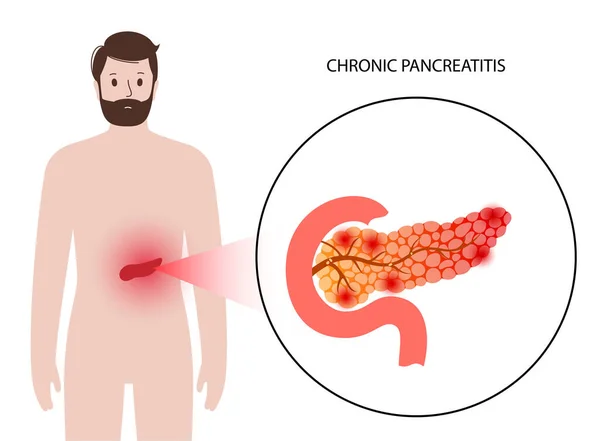 Malattia del pancreas e cancro — Vettoriale Stock