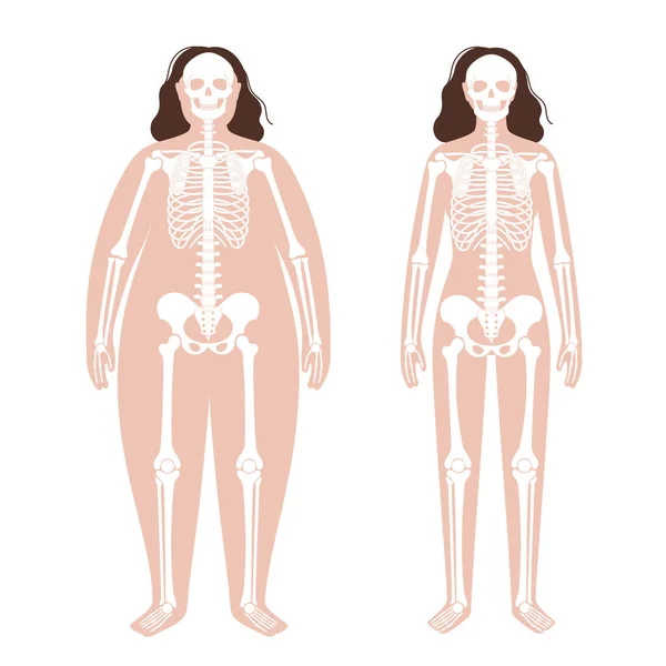 Obese skeleton anatomy — Stock Vector