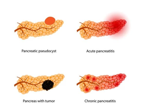 胰腺疾病和癌症 — 图库矢量图片