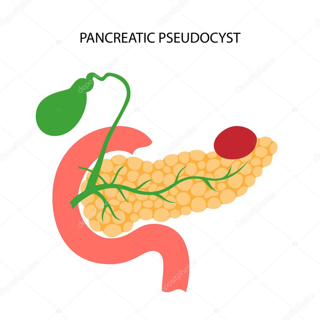 Pancreas disease concept. Acute and chronic pancreatitis, pancreatic cancer and pseudocyst. Pain and inflammation in digestive system. Human internal organs anatomical examination vector illustration.