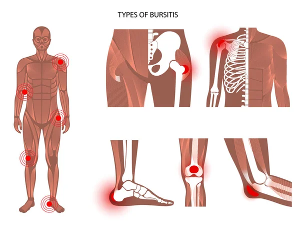 Bursitis图标设置 — 图库矢量图片