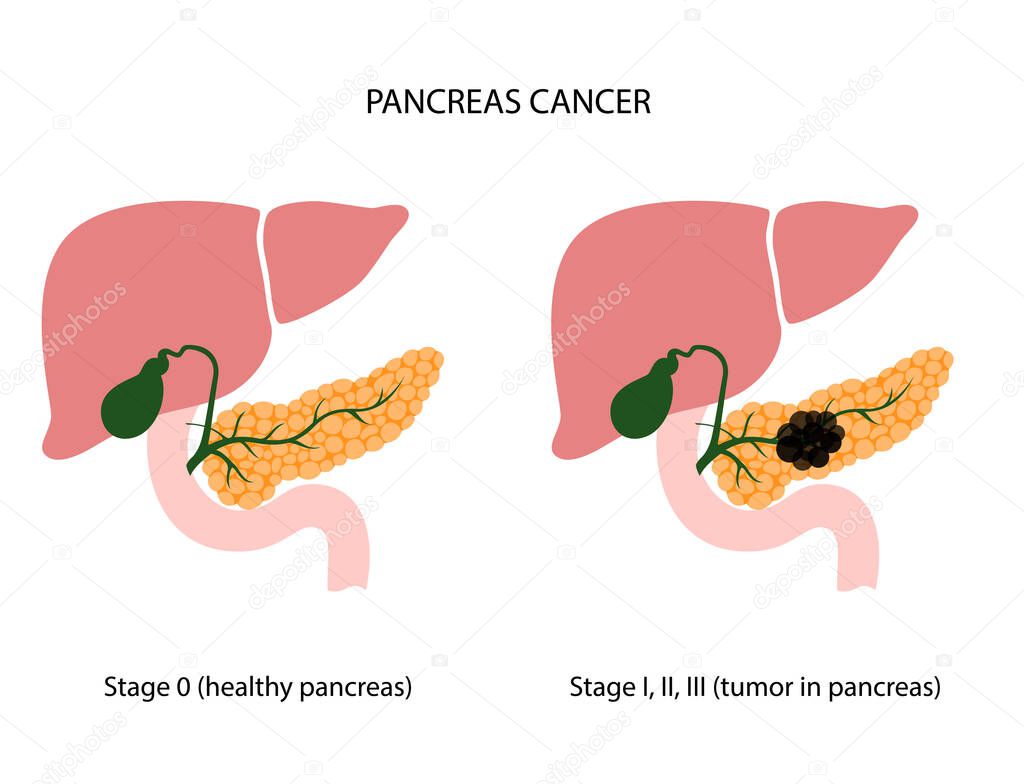 Pancreatic cancer logo. Pancreas with tumor and healthy organ. Medical appointment and treatment. Pain and inflammation in digestive system. Human internal organs anatomical poster vector illustration