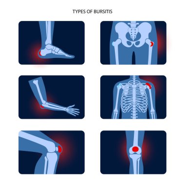 Bursitis simgeleri ayarlandı