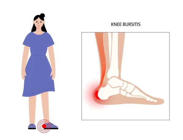 Concepto de inflamación de bursitis — Vector de stock