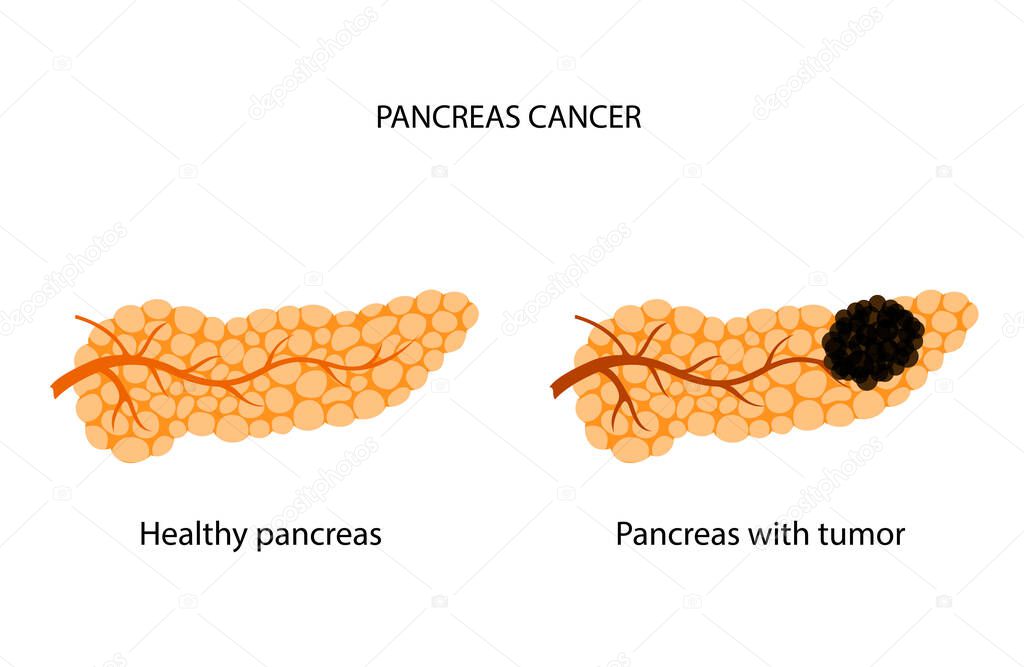 Pancreatic cancer logo. Pancreas with tumor and healthy organ. Medical appointment and treatment. Pain and inflammation in digestive system. Human internal organs anatomical poster vector illustration