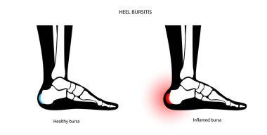 Bursitis iltihaplanma kavramı