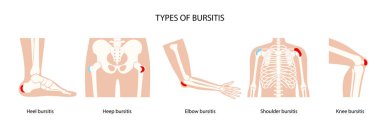 Bursitis simgeleri ayarlandı