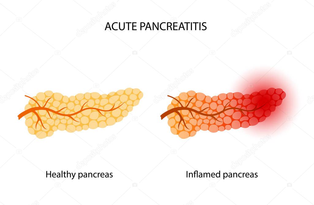 Acute pancreatitis logo. Healthy and inflamed pancreas. Medical appointment and treatment. Pain and inflammation in digestive system. Human internal organs anatomical poster flat vector illustration