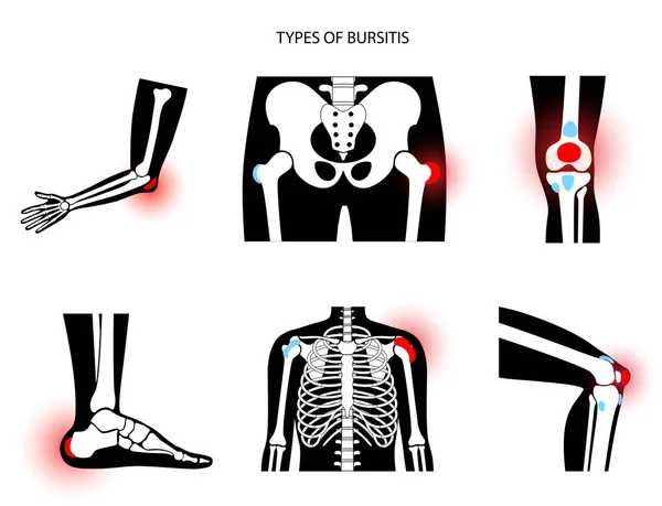Bursitis图标设置 — 图库矢量图片