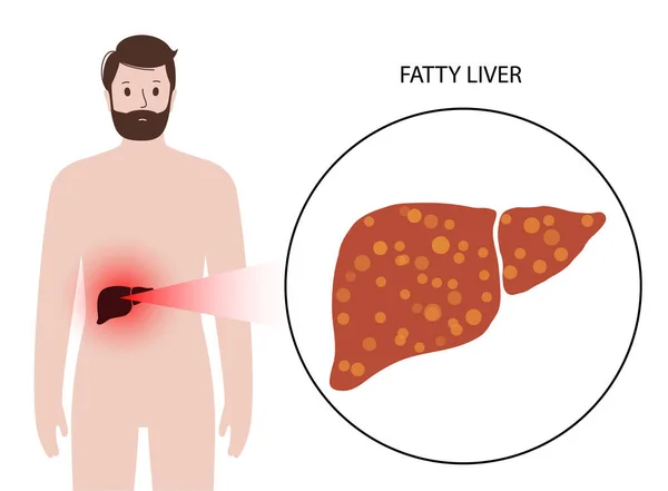 Begreppet leversjukdom — Stock vektor