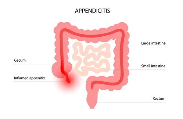 Apéndice concepto de dolor — Vector de stock