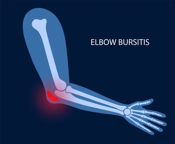 Bursitis del codo del estudiante — Vector de stock