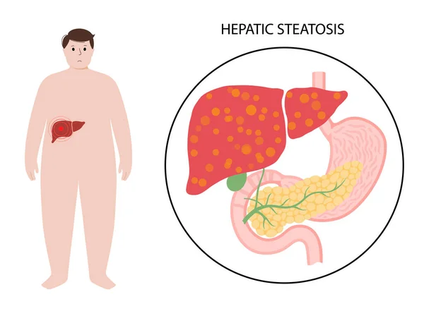 肝臓病の概念 — ストックベクタ
