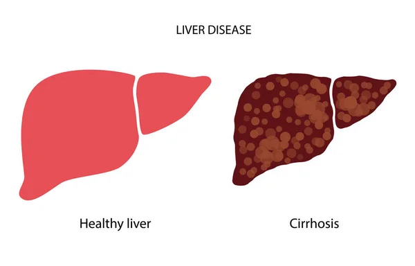 肝臓病の概念 — ストックベクタ