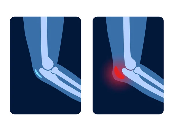 Bursitis-Rüstungskonzept — Stockvektor